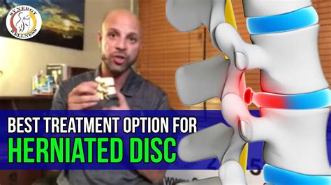 Herniated Disc Best Treatment Options Bulged Disc Youtube
