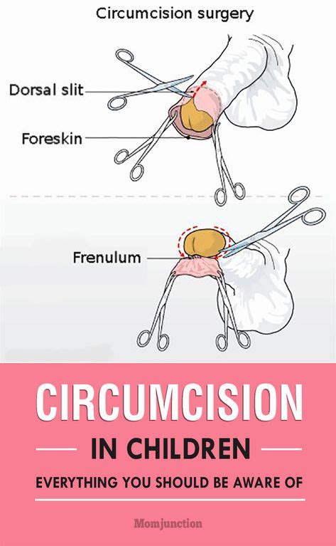 Best Circumcision Care Ideas Circumcision Circumcision Care Baby Care