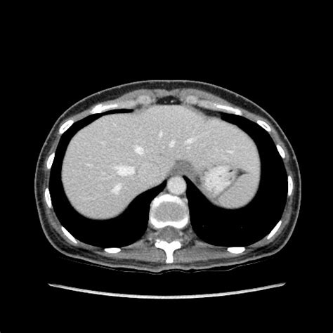 Cecal Diverticulitis Radiopaedia 67070 76394 A Nc Commons