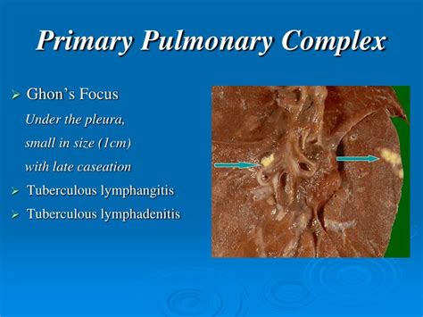 Ppt Lung Pathology Tuberculosis Powerpoint Presentation Id3595637