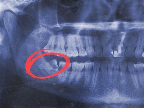 Impacted Wisdom Teeth Symptoms And Removal