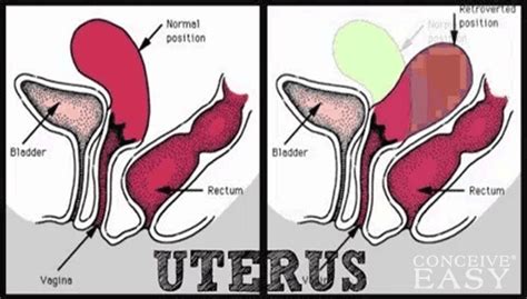 Some of the alterations in the shape of the uterus during pregnancy, such as transient asymmetry related to early gestation. How to Get Pregnant with Retroverted Uterus and PCOS ...