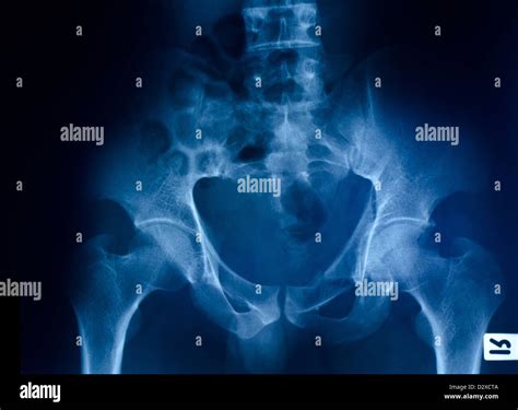 X Ray Film Of Pelvic Bone Stock Photo Alamy