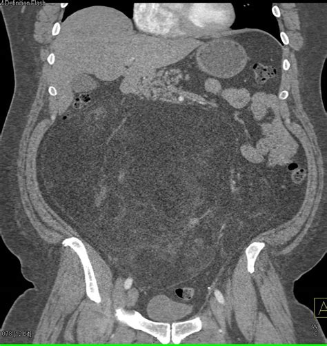 Abdominal Liposarcoma Gastrointestinal Case Studies Ctisus Ct Scanning