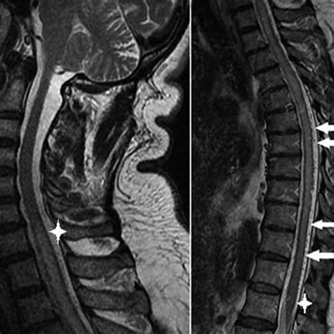 A T2 Weighted Cervical And B Thoracic Spine Sagittal Magnetic