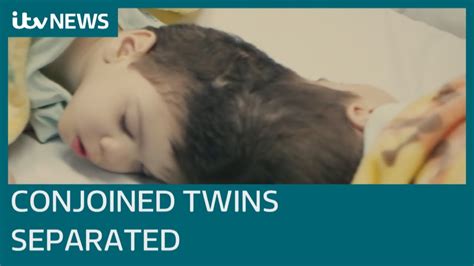 Conjoined Twins With Fused Brains Successfully Separated With Help Of