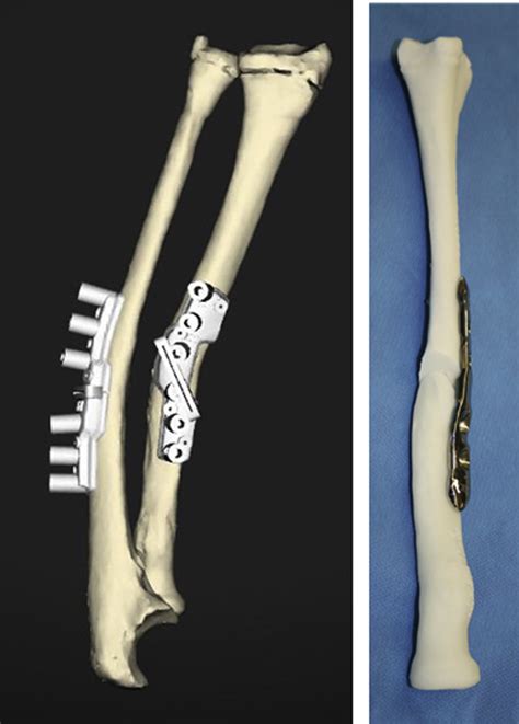 Corrective Osteotomy For Malunited Diaphyseal Forearm Fractures Using