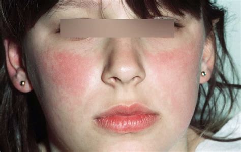 Fifth Disease Causes Incubation Period Rash And Fifth Disease Treatment