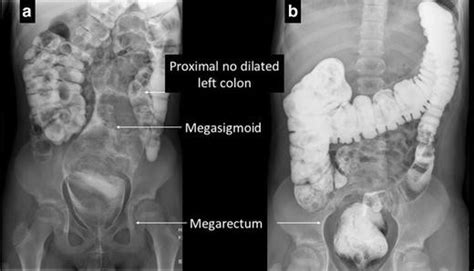 Contrast Enema Showing A Megarectosigmoid With A Normal Proximal