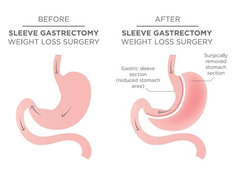 Vertical Sleeve Gastrectomygastric Sleeve Surgery Gold Coast