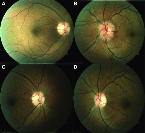 A Right Eye With Normal Appearance Of The Optic Nerve And Macula