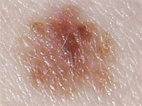 【症例画像・写真】皮膚がん・皮膚悪性腫瘍の症状・治療法 皮膚・爪・髪の病気 All About