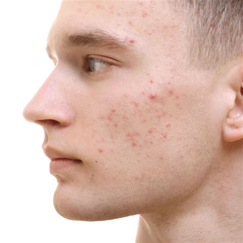 Bellevue Acne Treatment Pimples And Blackheads Acne Scar Treatment