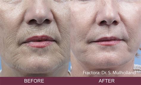 Fractora Skin Resurfacing Skin Excellence Clinics