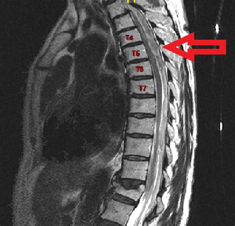 Cureus Spontaneous Spinal Subdural Hematoma Mimicking Myocardial