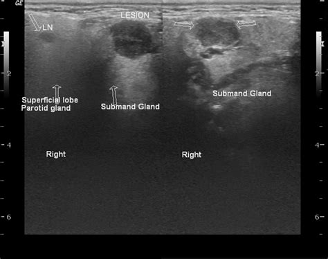Salivary Gland On Ultrasound