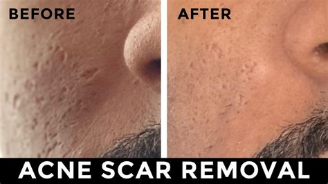 Acne Scar Removal Laser Fillers Subcision And Rf Microneedling Youtube