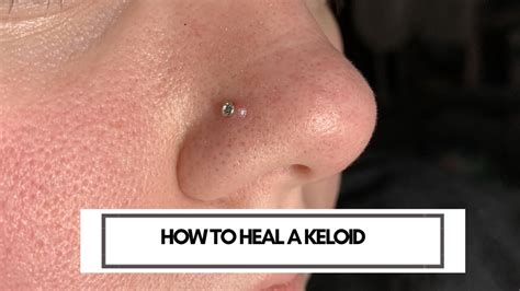 How To Heal A Keloid On A Nose Piercing Actually Works Youtube