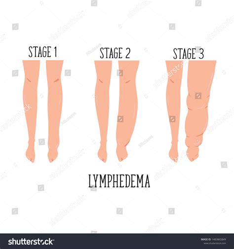 Lymphedema Stages Lymphatic System Disfunction Elephantiasis Vector Có