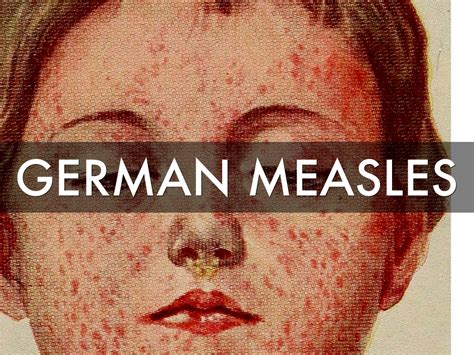 German Measles By Monica Velasco
