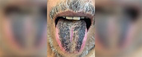 A Man Had A Stroke Three Months Later His Tongue Turned Hairy And Dark Sciencealert