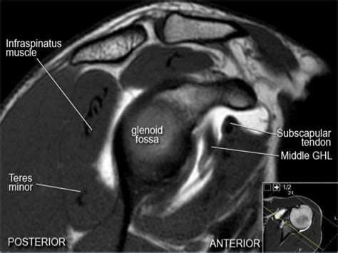 MRI Musculo-Skeletal Section: MRI anatomy of the shoulder (sagittal view).