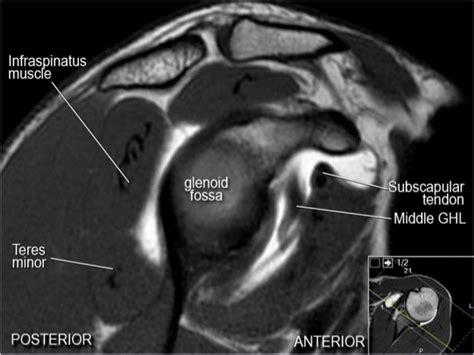 Mri Musculo Skeletal Section Mri Anatomy Of The Shoulder Sagittal View