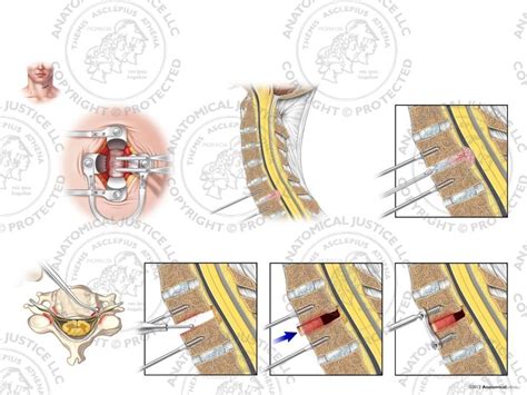 C Anterior Cervical Discectomy And Fusion With Bone Graft No Text