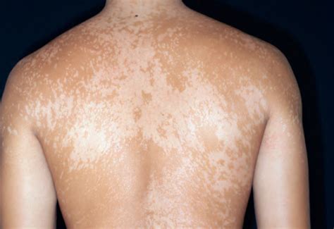 Tinea Versicolor Treatment Options Options Dermatology Games