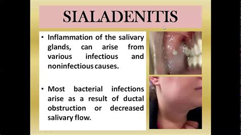 Salivary Gland Disease Part 2 Youtube