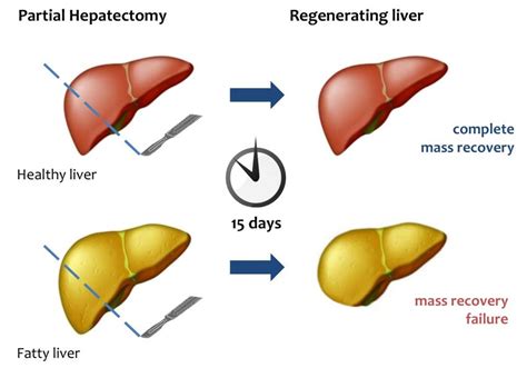 Diagram of the liver fatty liver causes symptoms and diagnosis. Liver regeneration failure in fatty liver. After PH, healthy liver can... | Download Scientific ...