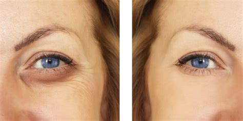 Under Eye Puffiness Treatment Health Sanctuary
