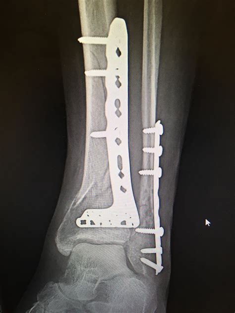 X Ray Left Ankle Spiral Fracture Tib Fib With Orif 3 Weeks Post Op