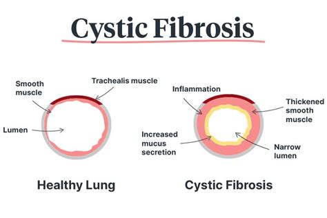 Symptoms And Treatment Of Cystic Fibrosis Ausmed