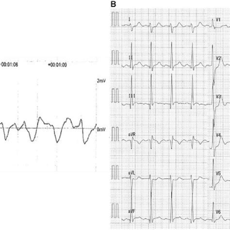 A Ventricular Fibrillation Waveform Documented On The Automated