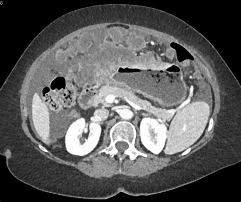 Gastric Adenocarcinoma With Liver Metastases And Carcinomatosis Liver