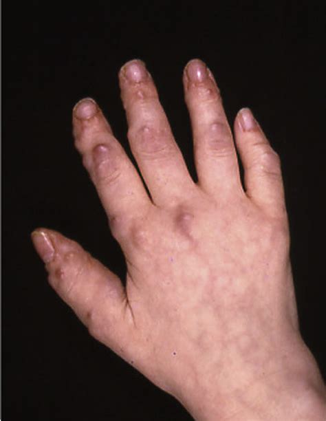 Figure 2 From Multicentric Reticulohistiocytosis And Fibroblastic