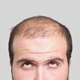 Future Hair Loss Treatments Images