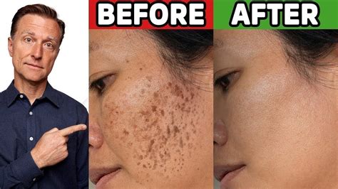How To Get Rid Of Hyperpigmentation Aging Or Dark Spots Youtube