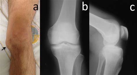 A Giant Medial Parameniscal Cyst Of The Knee Joint Bmj Case Reports