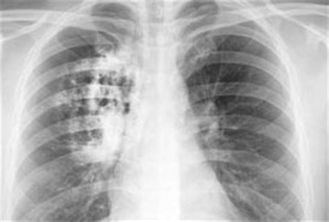 Mesothelioma is a deadly cancer of the lungs most often caused by inhaled asbestos particles. Asbestos Lung Cancer | Mesothelioma