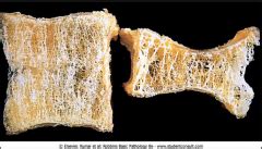 Bone Pathology Flashcards - Cram.com