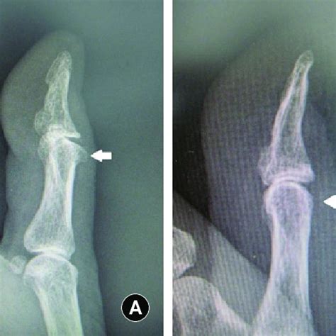 Osteophyte Of Interphalangeal Joint Of The Right Thumb A X Ray