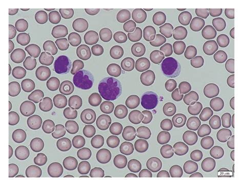 Microscopic Image Of Leukemic Lymphocytes In The Peripheral Blood Smear