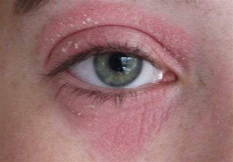Painful Red Rash Under Eyes Bing Images Eye Eczema Eczema Causes