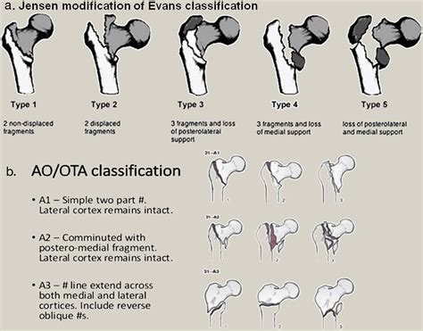 Overview Of Classification And Surgical Management Of Hip Fractures Orthopaedics And Trauma