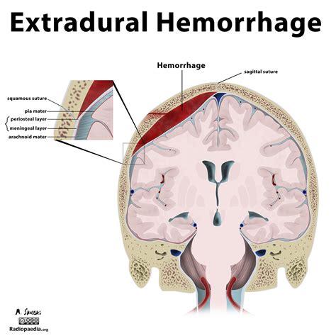 A patient with a subdural hemorrhage usually presents with severe headache and confusion. Diagram - intracranial haemorrhage | Image | Radiopaedia.org