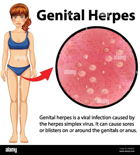 Infograf A Del Herpes Genital Con Ilustraci N Explicativa Imagen Vector De Stock Alamy