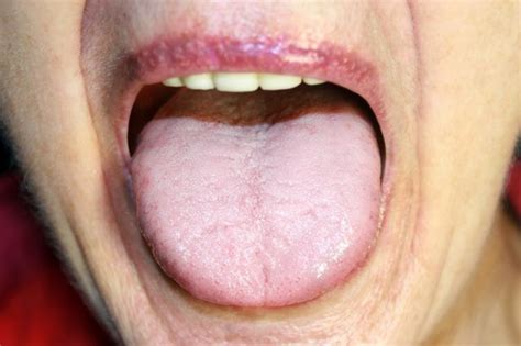 Why Is My Tongue White Causes Symptoms Treatment Pictures