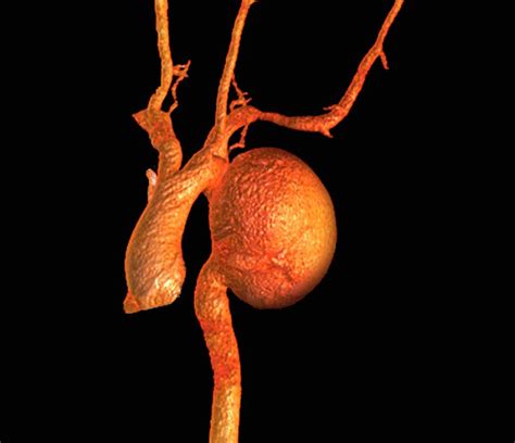 Aortic Aneurysm Photograph By Zephyrscience Photo Library Pixels